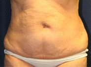 Tummy Tuck 04 Before 1