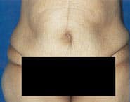 Tummy Tuck 11 Before 1