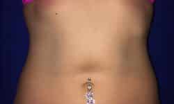 CoolSculpting 01 After