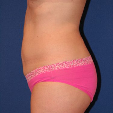 Liposuction 02 After 2