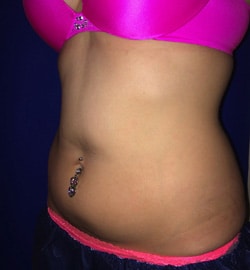 CoolSculpting 01 After 2