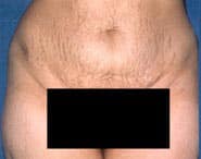 Tummy Tuck 10 Before