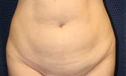 Liposuction 02 Before