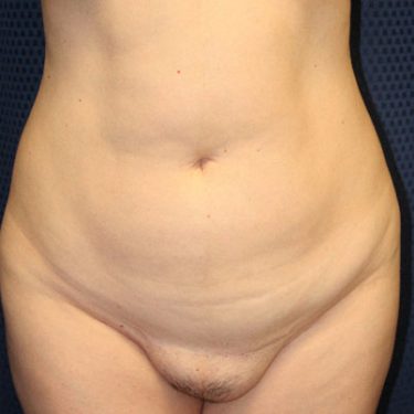 Liposuction 02 Before 1