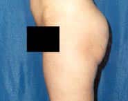 Tummy Tuck 12 Before 2