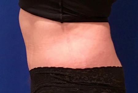 Tummy Tuck 01 After 2