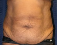 Tummy Tuck 06 Before 1