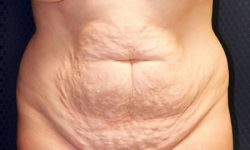 Tummy Tuck 01 Before