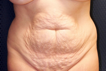 Tummy Tuck 01 Before 1