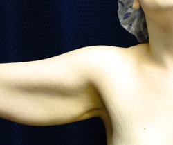 Arm Lift 02 Before 1