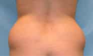 Liposuction 03 Before 3