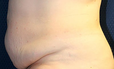 Tummy Tuck 03 Before 2