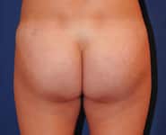 Fat Transfer / Brazilian Butt Lift 01 After 2