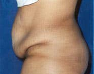 Tummy Tuck 11 Before 2