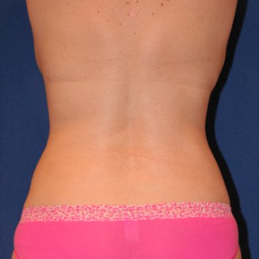 Liposuction 02 After 3