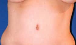 Tummy Tuck 03 After