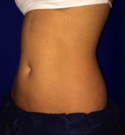 CoolSculpting 02 After 2