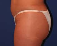 Fat Transfer / Brazilian Butt Lift 04 After 1