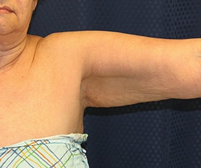 Arm Lift 01 Before 2