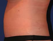 Tummy Tuck 05 After 2