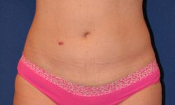 Liposuction 02 After