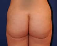 Fat Transfer / Brazilian Butt Lift 02 After