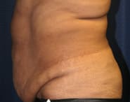 Tummy Tuck 06 Before 2