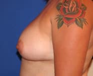 Fat Transfer / Brazilian Butt Lift 03 After 2