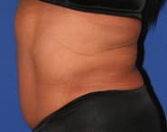 Tummy Tuck 06 After 2