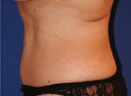 Tummy Tuck 04 After 2