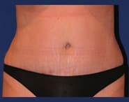 Tummy Tuck 05 After 1