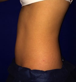 CoolSculpting 02 After 3