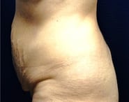 Tummy Tuck 07 Before 2