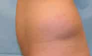 Liposuction 03 Before 2