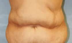 Tummy Tuck 02 Before