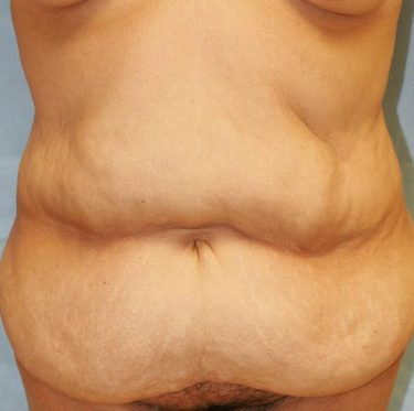 Tummy Tuck 02 Before 1