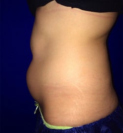 CoolSculpting 01 Before 3