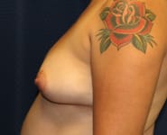 Fat Transfer / Brazilian Butt Lift 03 Before 2