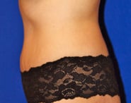 Tummy Tuck 07 After 2