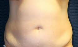 Tummy Tuck 03 Before