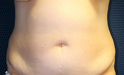 Tummy Tuck 03 Before 1