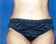 Tummy Tuck 11 After 1