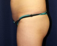 Fat Transfer / Brazilian Butt Lift 01 Before 1