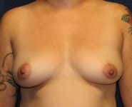 Fat Transfer / Brazilian Butt Lift 03 Before