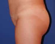 Fat Transfer / Brazilian Butt Lift 01 After