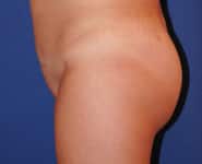 Fat Transfer / Brazilian Butt Lift 01 After 1