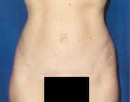 Tummy Tuck 12 After 1