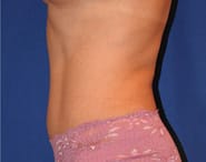 Tummy Tuck 08 After 2