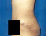 Tummy Tuck 11 After 2