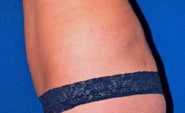 Liposuction 03 After 2